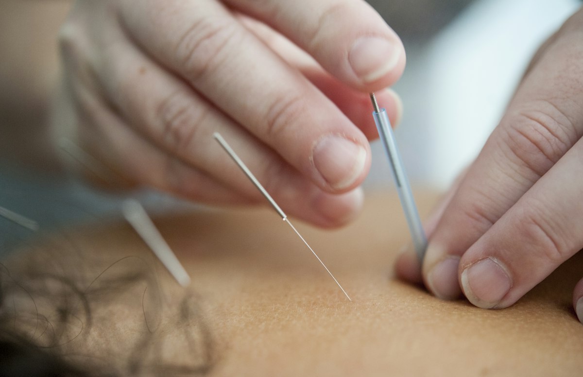 An acupuncturist placing a needle with a guide tube